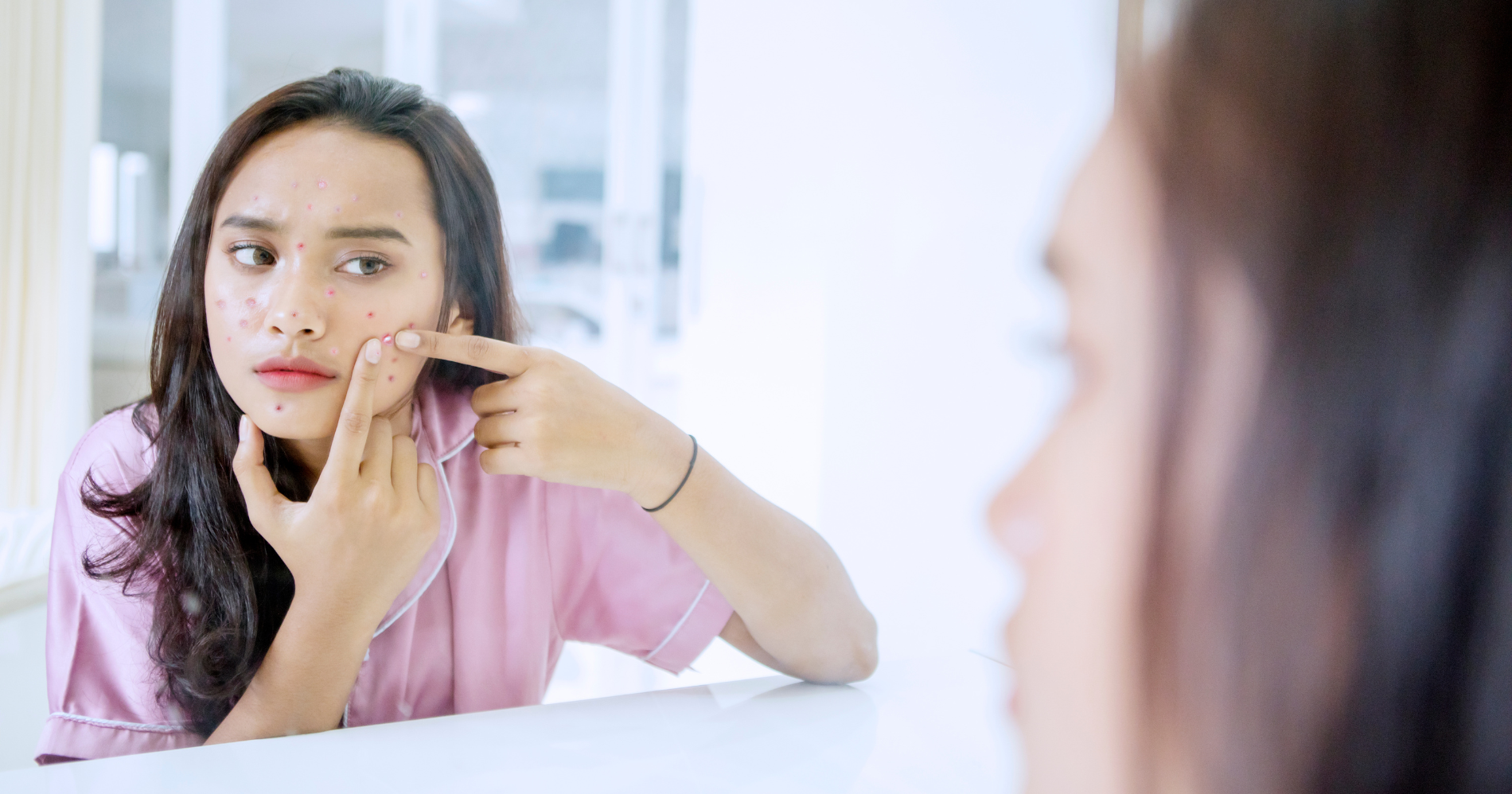 Jerawat bisa diatasi, baik dengan menggunakan obat sintesis atau alami (Foto: Canva)