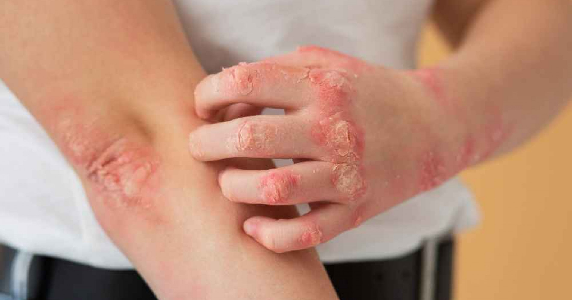 Virus Mpox jadi masalah kesehatan yang perlu diperhatikan oleh banyak pihak. (Foto Freepik.com)